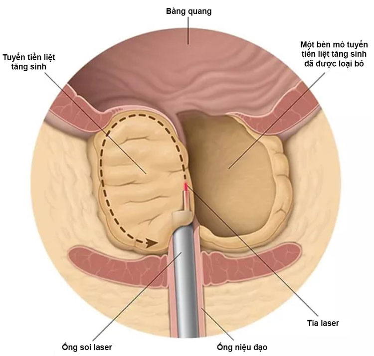     Mổ nội soi tuyến tiền liệt bằng laser gây ra nhiều tác dụng phụ