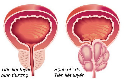 Phì đại tuyến tiền liệt có nguy hiểm không?