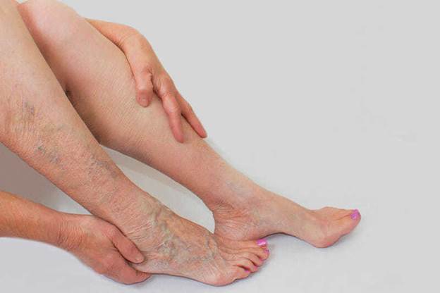 Kết quả hình ảnh cho Varicose veins