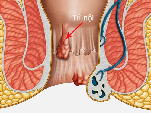 Bệnh trĩ nội: khái niệm, dấu hiệu, nguyên nhân và cách trị