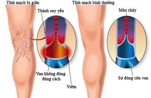 Suy giãn tĩnh mạch chân