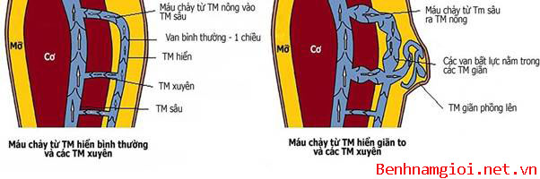 Bệnh lý suy van tĩnh mạch sâu