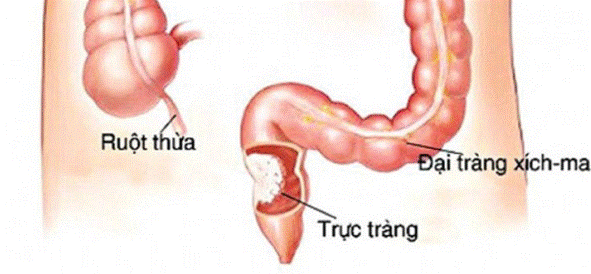 Ung thư trực tràng có nhiều biểu hiện giống với bệnh trĩ