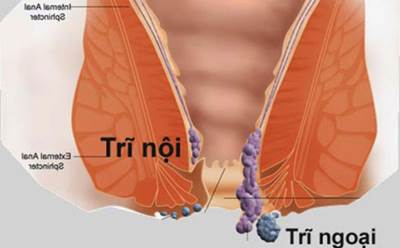 Nhiều người có suy nghĩ sai lầm về bệnh trĩ