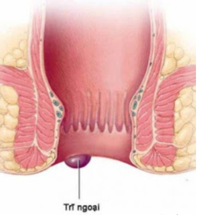 Bệnh trĩ ngoại cấp độ 2 là gì?