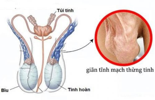 Giãn tĩnh mạch thừng tinh ở nam giới