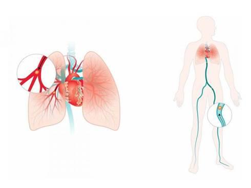 Biến chứng tắc mạch phổi