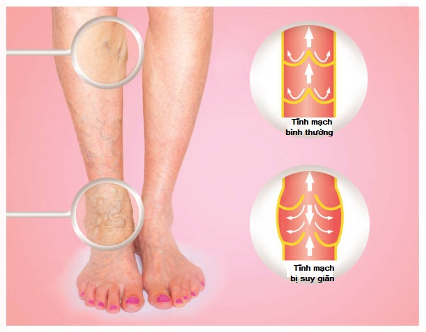 Cách chữa bệnh suy giãn tĩnh mạch chân là gì?