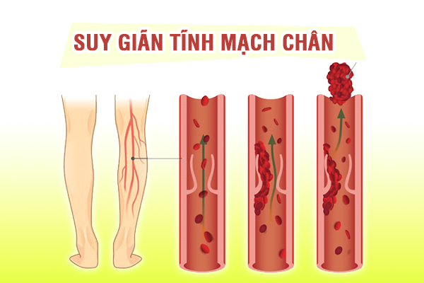 Suy giãn tĩnh mạch chân có thể gây biến chứng huyết khối tĩnh mạch sâu nguy hiểm