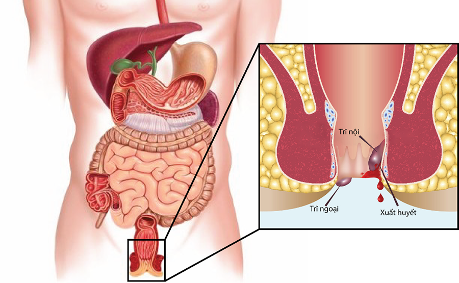 Bệnh trĩ là gì?