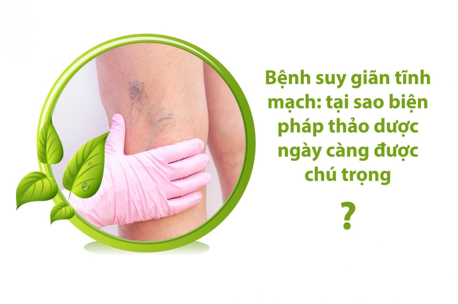 Bệnh suy giãn tĩnh mạch: tại sao biện pháp thảo dược ngày càng được chú trọng?