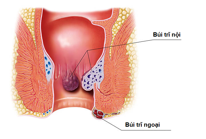 Vị trí của búi trĩ nội và búi trĩ ngoại