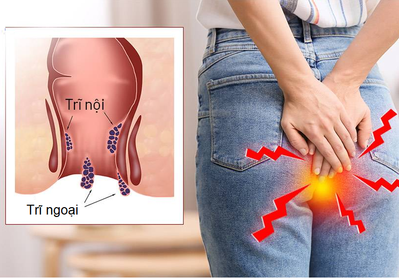 Rát hậu môn là biểu hiện của bệnh trĩ