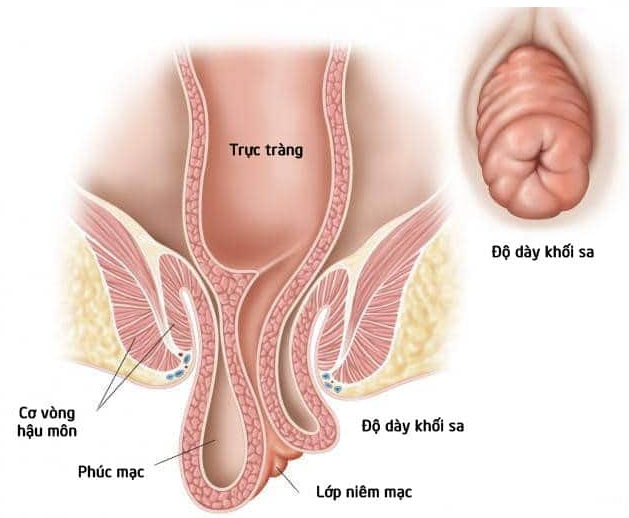 Bệnh sa trực tràng