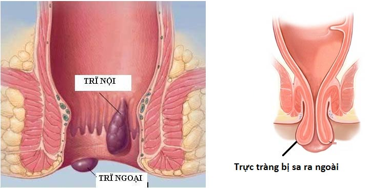 Cách phân biệt sa trực tràng và trĩ là gì?