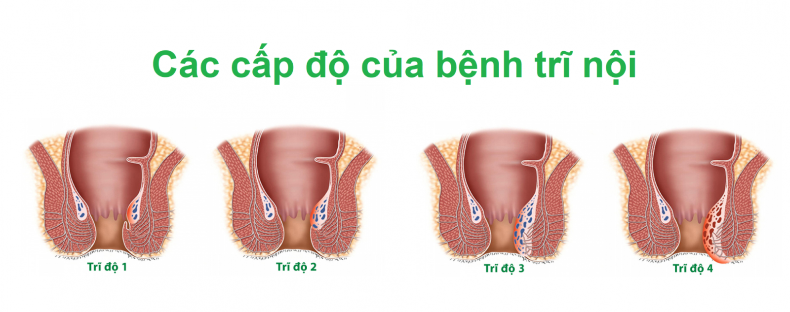 Các cấp độ của bệnh trĩ nội