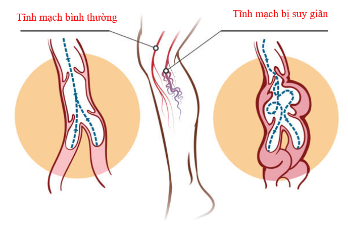  Suy giãn tĩnh mạch chân là nguyên nhân hàng đầu gây chuột rút khi ngủ