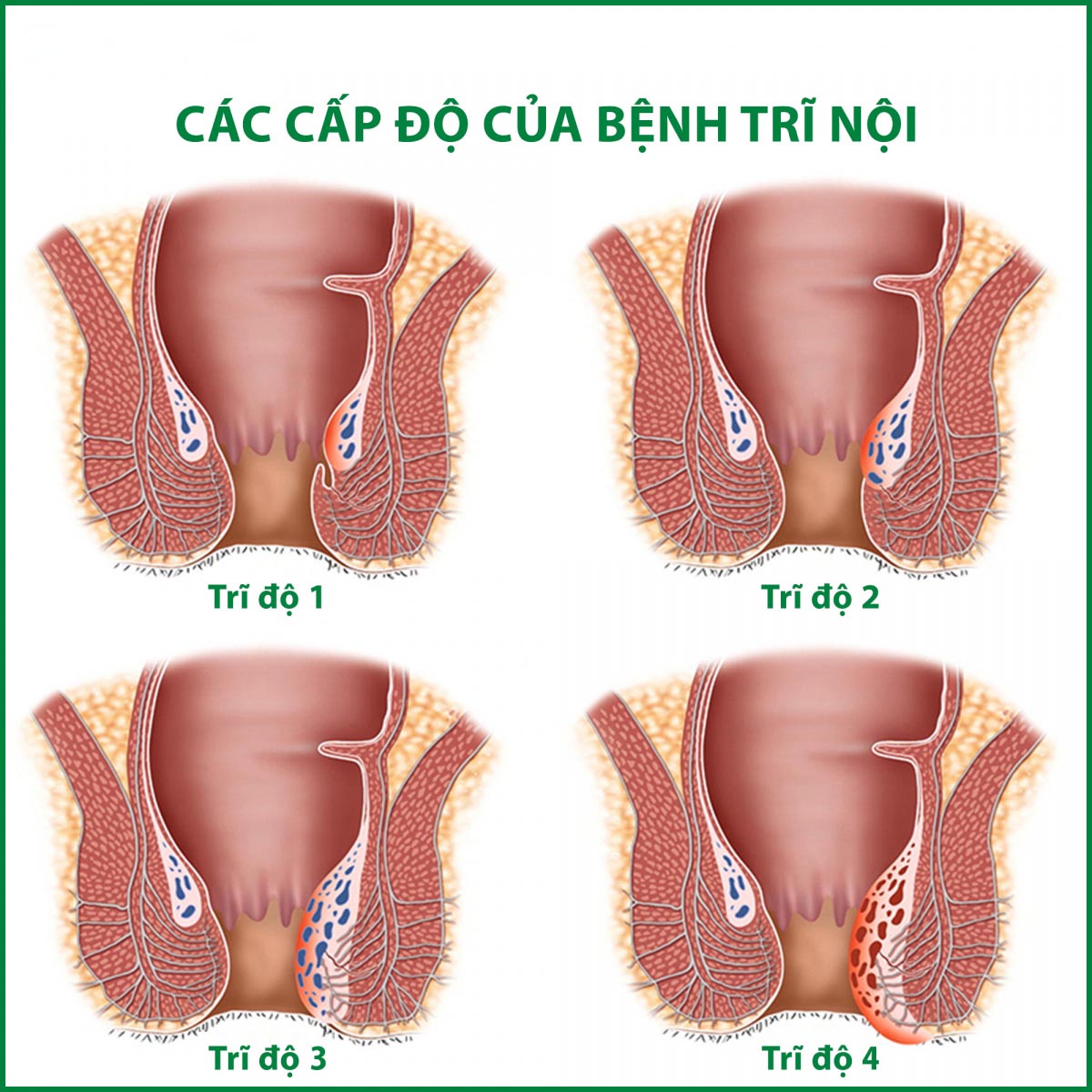 Các cấp độ của bệnh trĩ nội