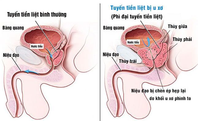 Bệnh u phì đại lành tính tuyến tiền liệt là gì?