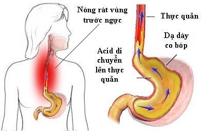 bệnh trào ngược dạ dày thực quản