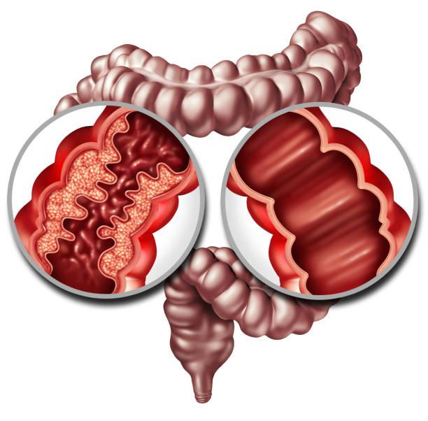 Tiêu chảy sau khi uống rượu bia có thể là dấu hiệu cảnh báo IBS