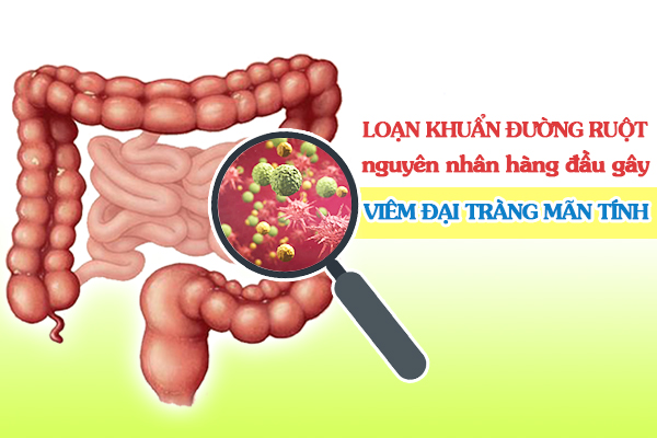 Loạn khuẩn đường ruột là nguyên nhân hàng đầu gây viêm đại tràng mãn tính