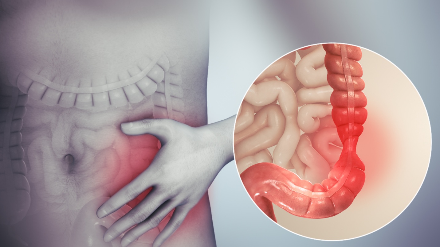 Căng thẳng, stress gây ra những cơn co thắt trong hội chứng ruột kích thích.