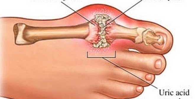 Hỏi: BoniGut có ngăn được biến chứng bệnh gút không?