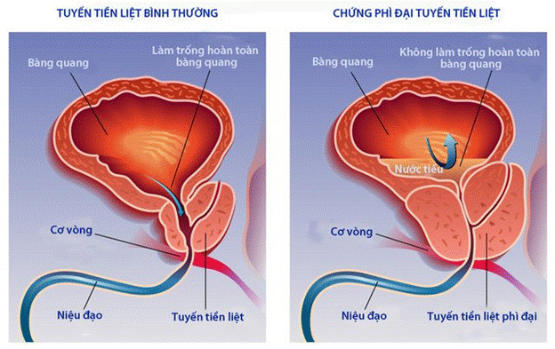 Hình ảnh phì đại tuyến tiền liệt