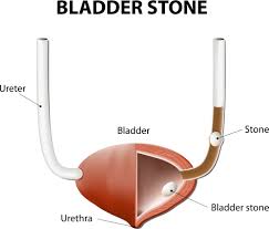 Biến chứng phì đại tuyến tiền liệt