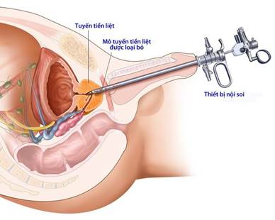 Phương pháp ngoại khoa phẫu thuật phì đại tuyến tiền liệt