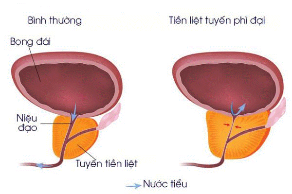 Bệnh phì đại tuyến tiền liệt