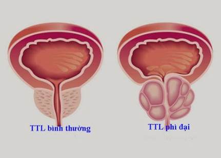 Tuyến tiền liệt bị phì đại