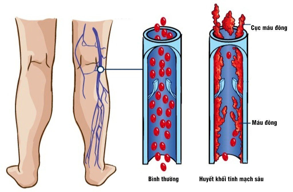 Huyết khối tĩnh mạch sâu nguy hiểm thế nào?