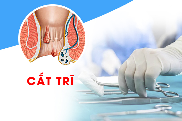 Cắt trĩ rồi thì bệnh có tái phát lại không?