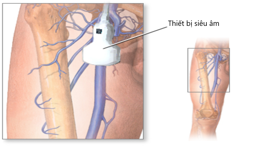 Siêu âm doppler tĩnh mạch chi dưới là gì?