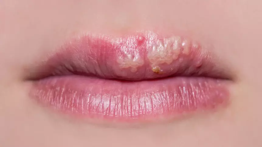 Herpes miệng