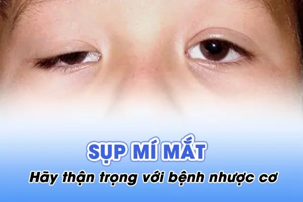 Sụp mí mắt