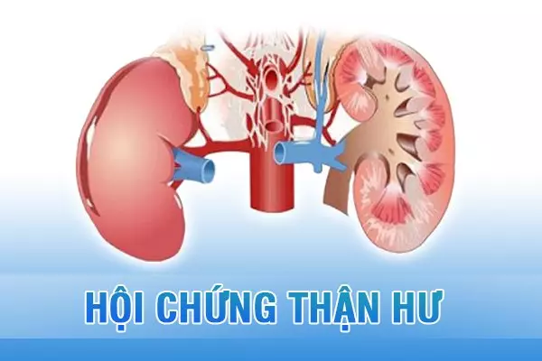 Hội chứng thận hư là bệnh gì, có chữa khỏi được không?