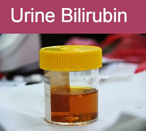 Bilirubin trong nước tiểu