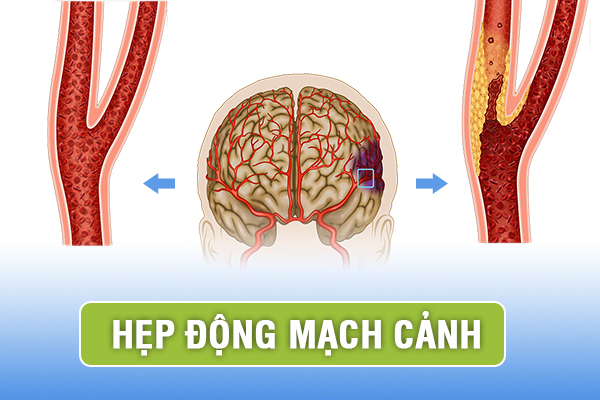 hẹp động mạch cảnh