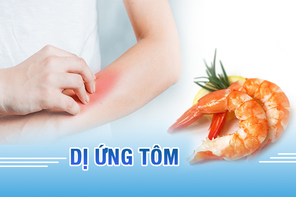 Dị ứng tôm – Cẩn thận kẻo nguy hiểm đến tính mạng