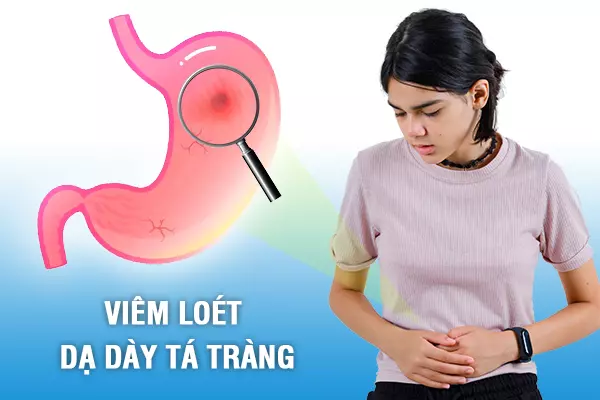 vi khuẩn gây viêm loét dạ dày tá tràng