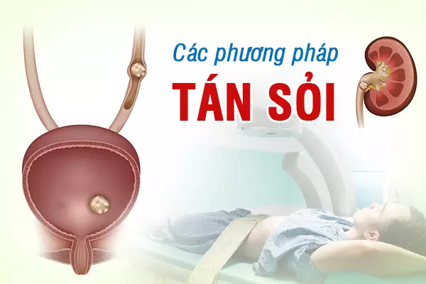 Các phương pháp tán sỏi thông dụng hiện nay