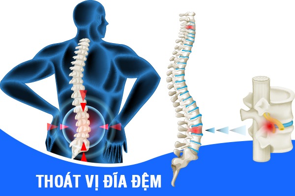 Thoát vị đĩa đệm là gì? Các phương pháp điều trị