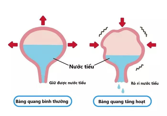 Bàng quang tăng hoạt - Nỗi khổ tâm khi đứng ngồi không yên vì buồn tiểu