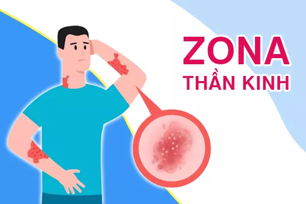 Zona thần kinh có nguy hiểm không?