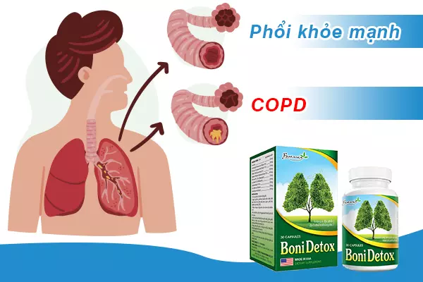 Chuyên gia giải đáp: Bệnh phổi tắc nghẽn mãn tính COPD và công dụng của BoniDetox