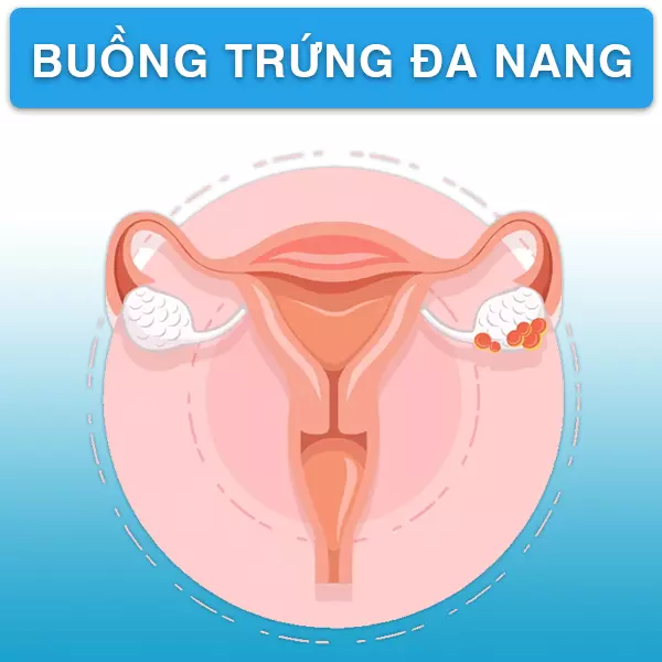 Hội chứng buồng trứng đa nang