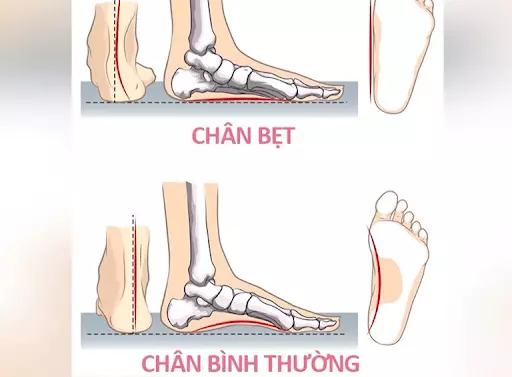 Người mắc bàn chân phẳng sẽ không có vòm chân
